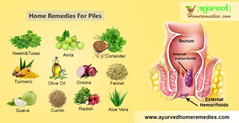 10 Best Home Remedies For Treating Piles How To Get Rid Of Hemorrhoids 9904