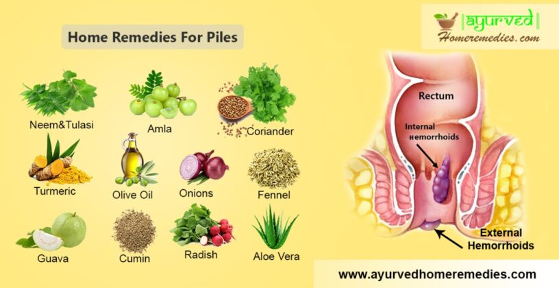 10 Best Home Remedies For Treating Piles How To Get Rid Of Hemorrhoids   WhatsApp Image 2021 06 08 At 6.18.06 PM 816x420 