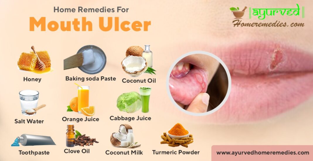 Home Remedies To Cure Mouth Ulcers How To Get Rid Of