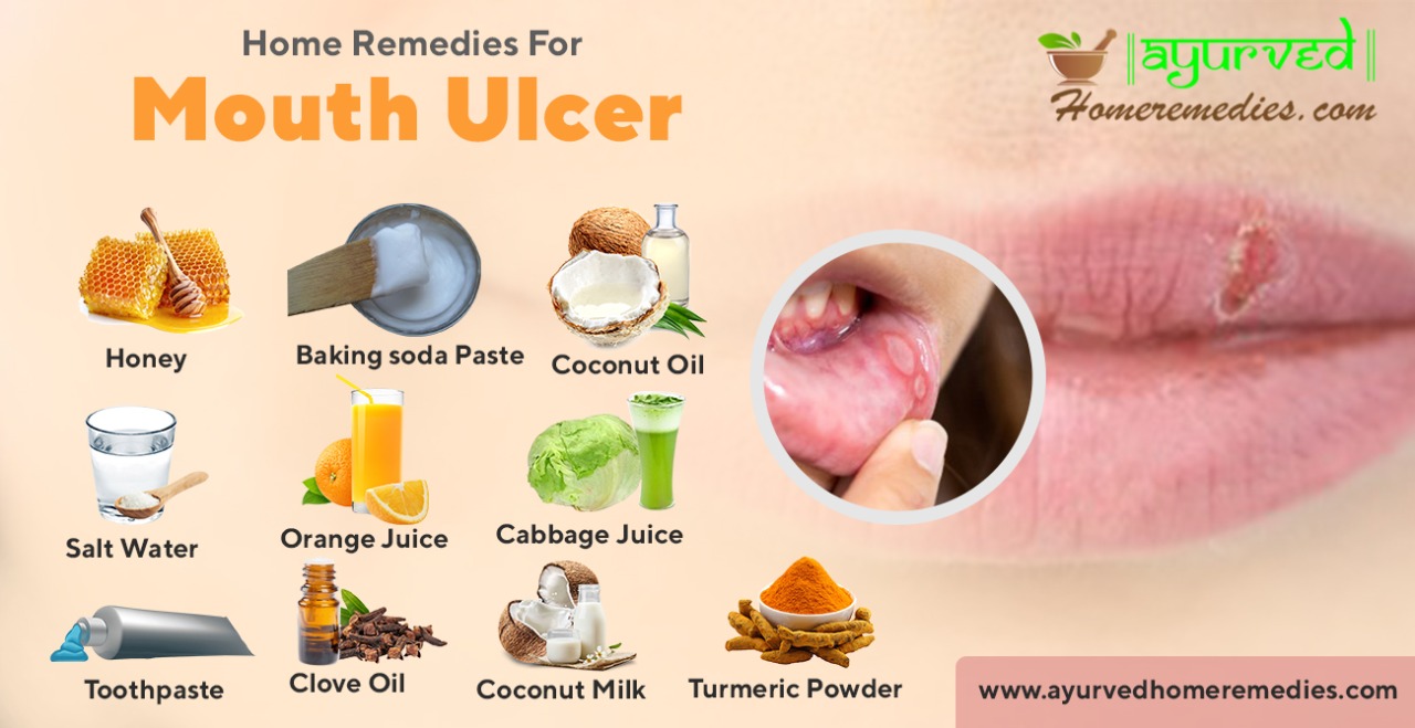 Who Else Wants Info About How To Reduce Mouth Ulcers - Effectsteak33